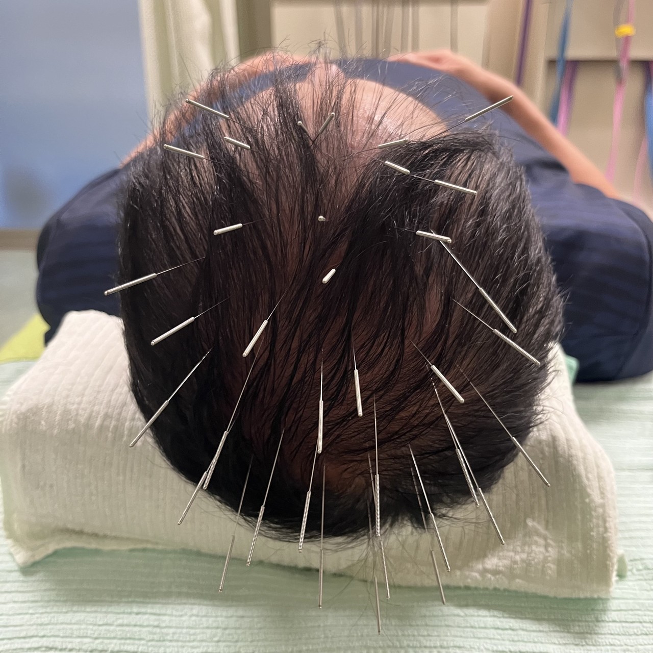 頭皮に多数の鍼を打った薄毛改善鍼の施術の様子（俯瞰）