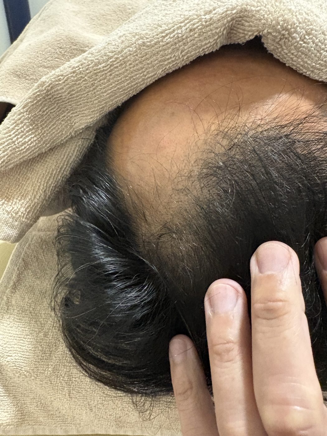 薄毛改善鍼を5回受けたあとのMさんの頭頂部・前髪のはえぎわ