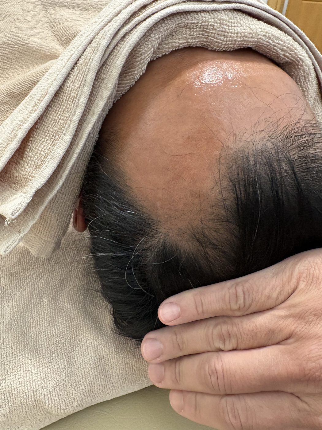 薄毛改善鍼を受ける前のMさんの頭頂部・前髪のはえぎわ