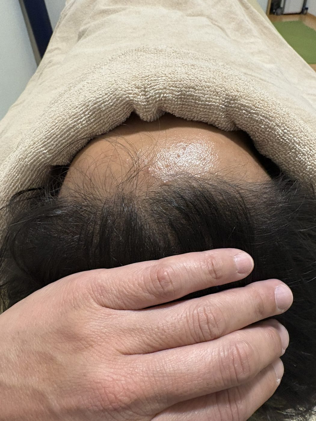 薄毛改善鍼を7回受けたあとのYさんの頭頂部