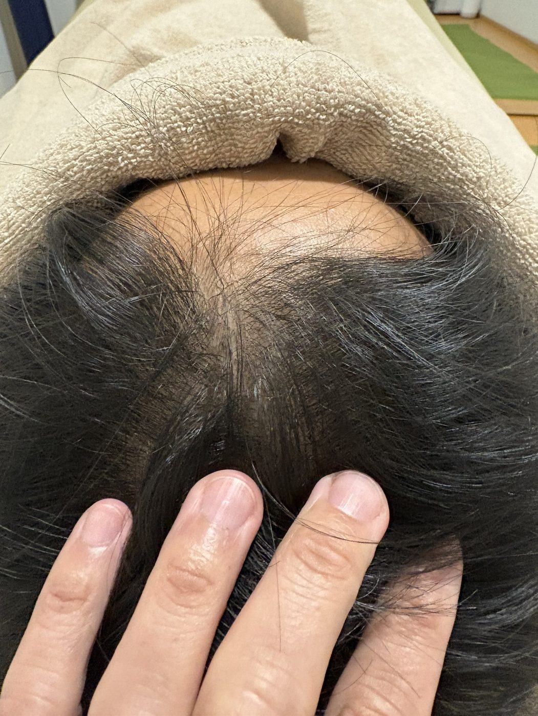 薄毛改善鍼を受ける前のYさんの頭頂部